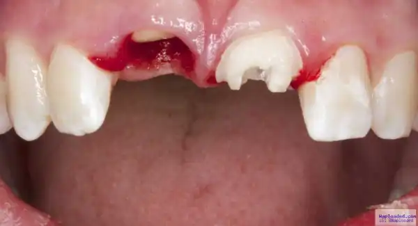 7 Common Habits That Damages Your Teeth